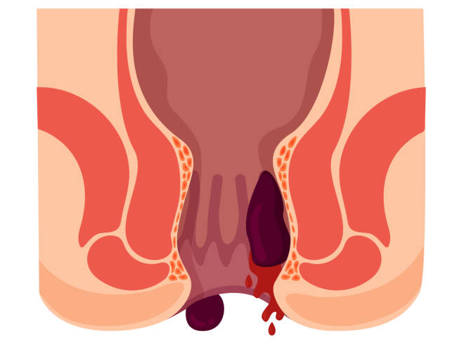 Bệnh trĩ gây chảy máu kéo dài khiến người bệnh dễ bị thiếu máu