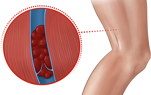 Suy giãn tĩnh mạch chân dẫn đến hình thành cục máu đông rất nguy hiểm