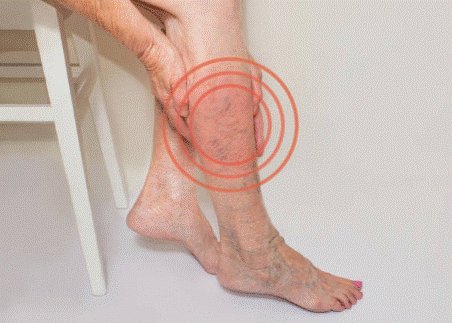 Tê bì chân kèm theo đau nặng mỏi, nổi gân xanh… là triệu chứng của suy giãn tĩnh mạch chân