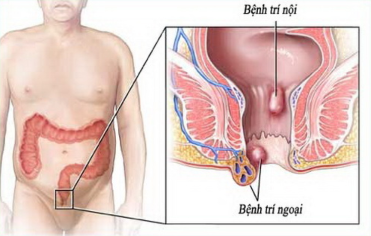 Trĩ nội và trĩ ngoại là 2 dạng phổ biến của bệnh trĩ