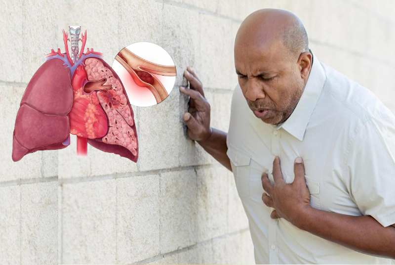 Thuyên tắc phổi gây khó thở, đau ngực, người bệnh có thể tử vong sau thời gian rất ngắn