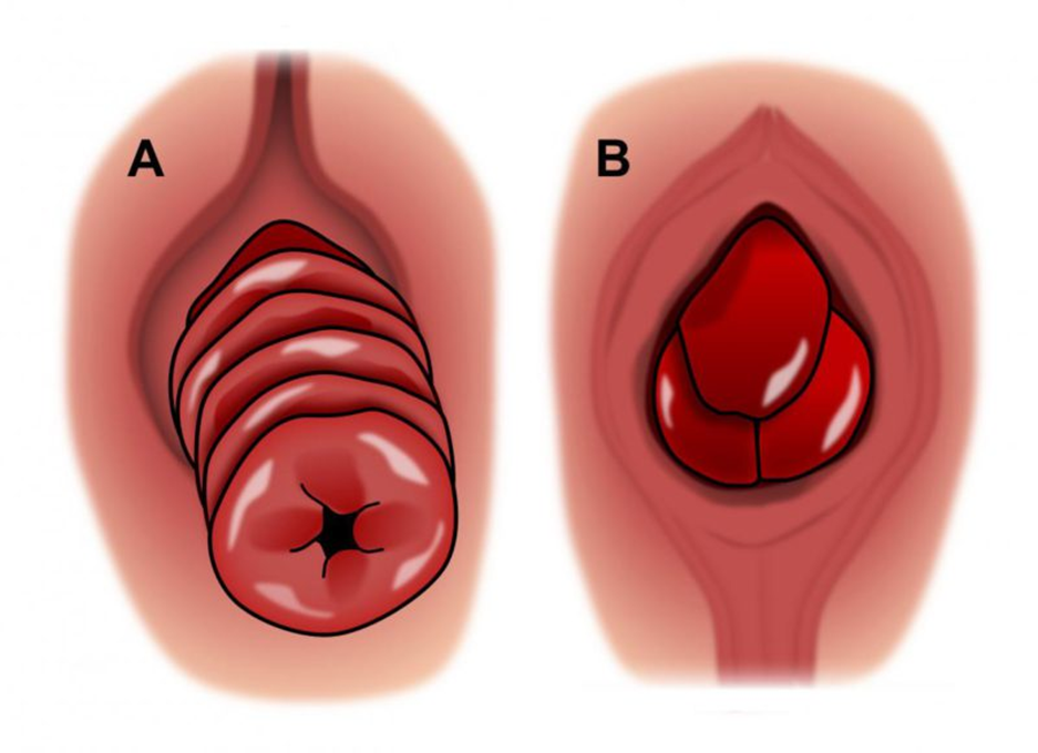 Toàn cảnh khối sa trực tràng toàn bộ (A) và sa trực tràng một phần (B)