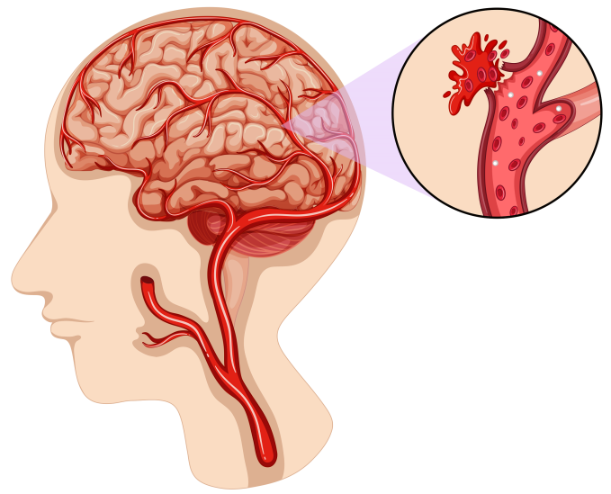 Hút thuốc lá làm tăng nguy cơ đột quỵ não