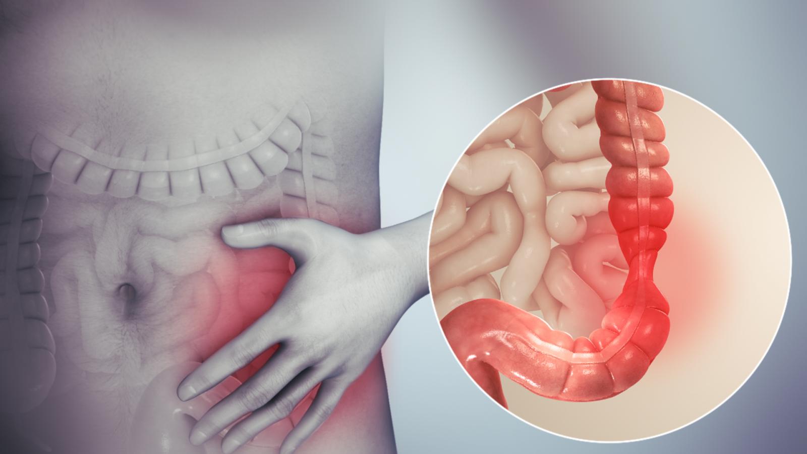 Hội chứng ruột kích thích gây đau quặn bụng, đầy hơi, ăn không tiêu