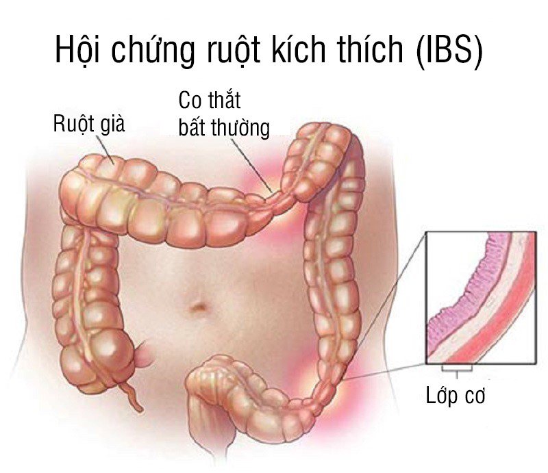 Hội chứng ruột kích thích gây đau bụng từng cơn
