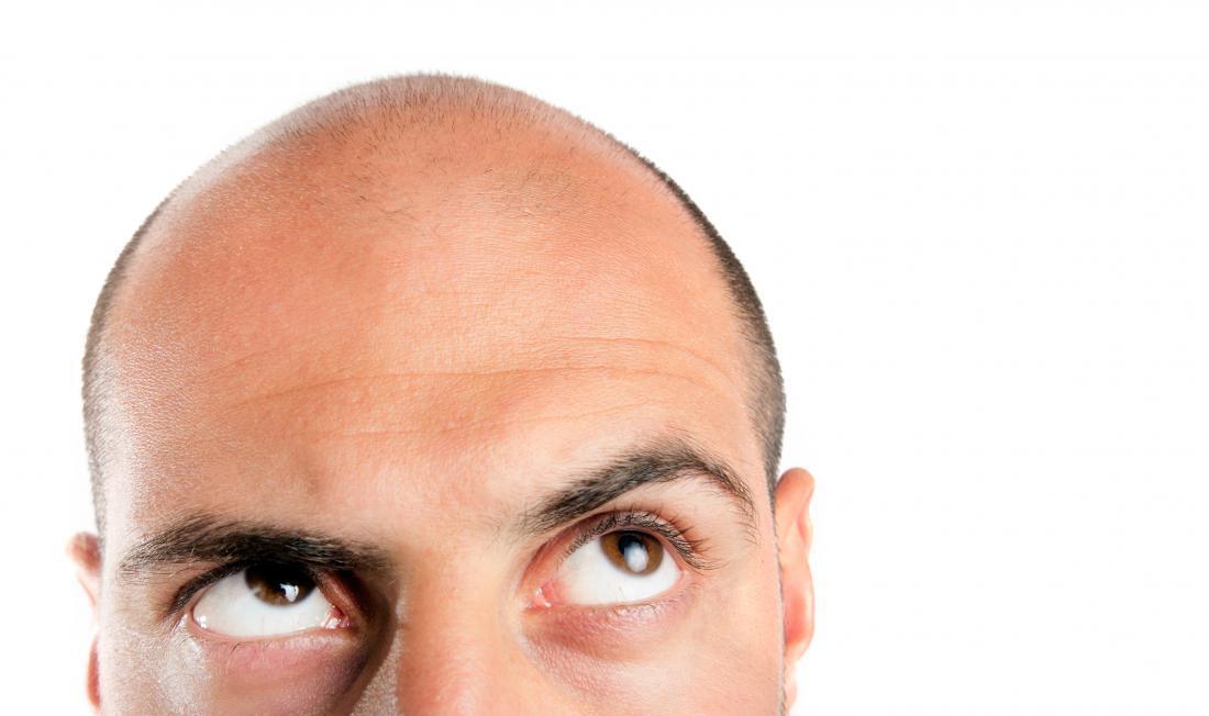 Hói đầu là hệ quả của việc rụng tóc diễn ra trong thời gian dài
