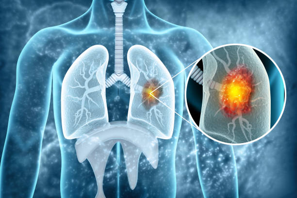Nhiễm độc phổi là nguyên nhân hình thành bệnh COPD