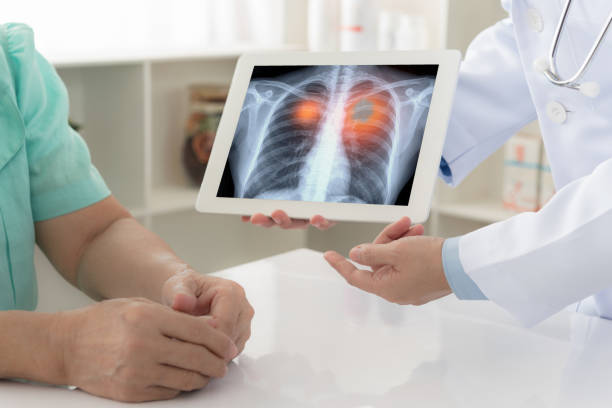 Vôi hóa phổi có thể do ung thư phổi.