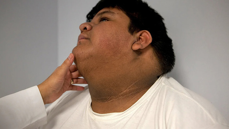  Người béo phì cũng có thể bị bệnh gai đen do kháng insulin.