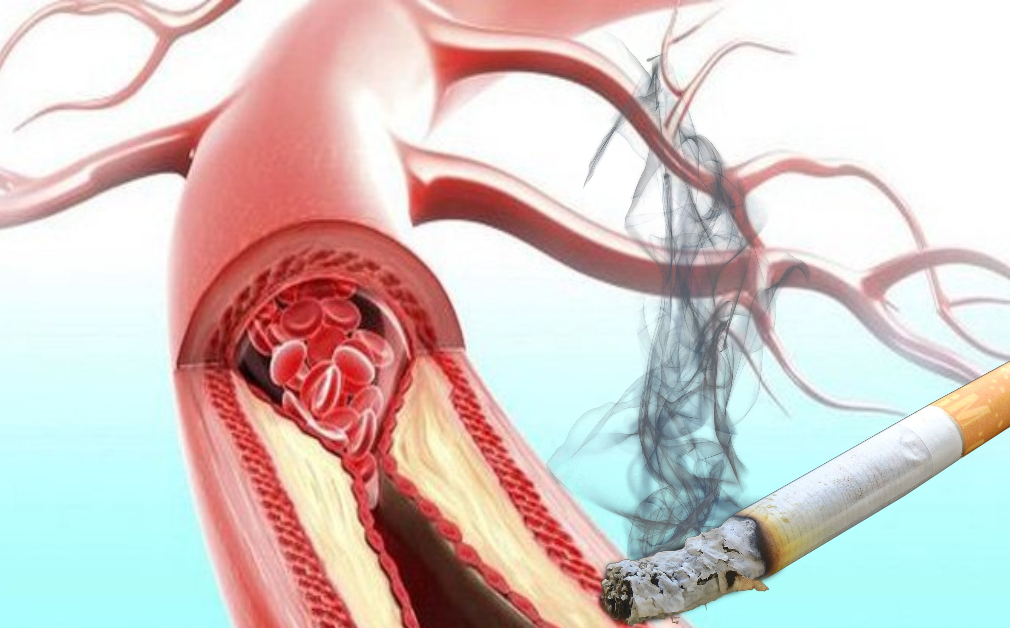  Tăng nguy cơ xơ vữa động mạch và tắc mạch ở người hút thuốc lá