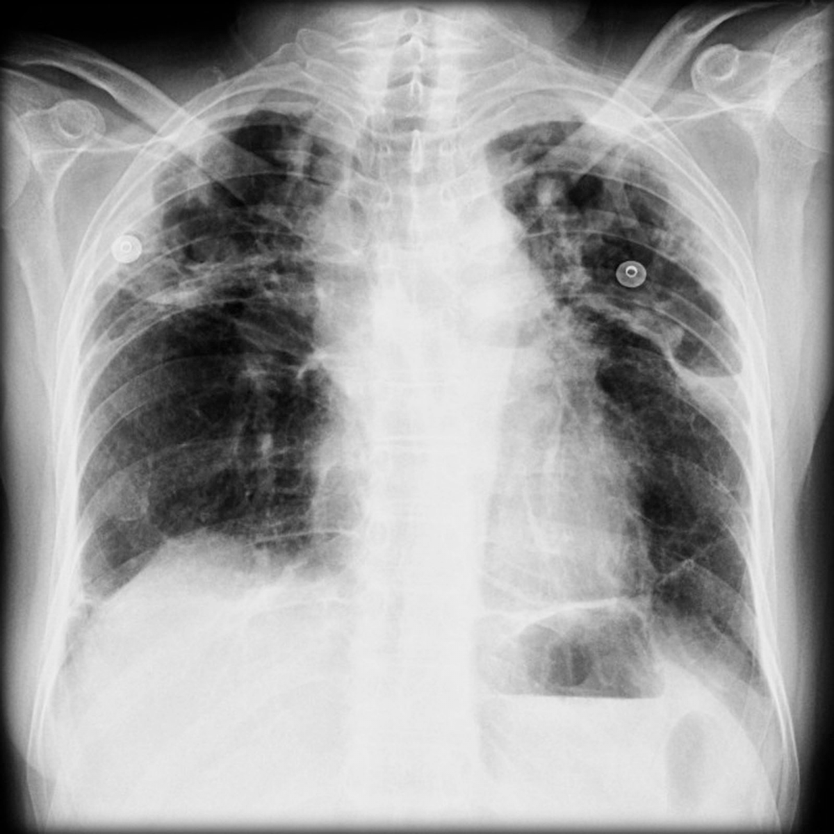 Phổi của người bị bụi phổi silic