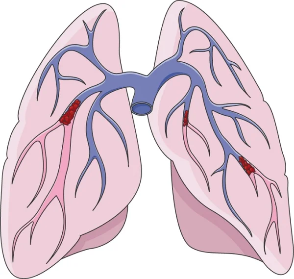 Huyết khối tĩnh mạch sâu có thể dẫn đến thuyên tắc phổi