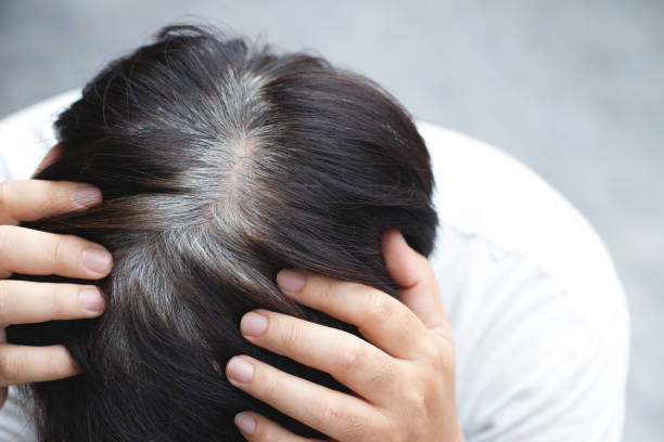  Nguyên nhân gây tóc bạc sớm là gì?