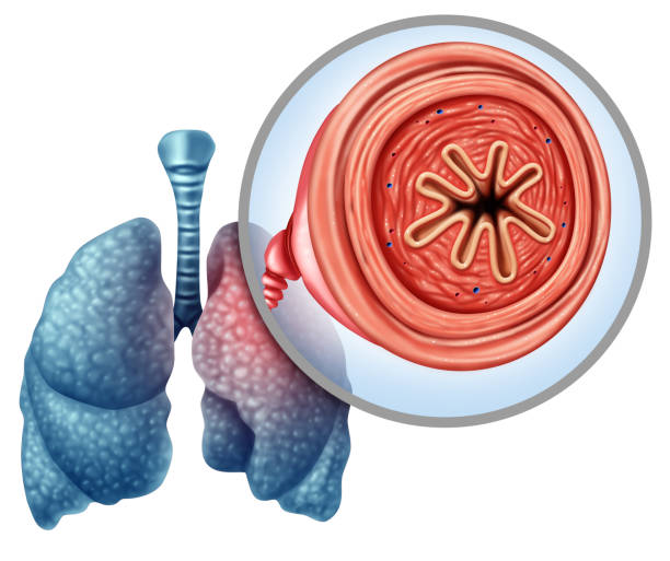  Người bị COPD nên tầm soát ung thư phổi
