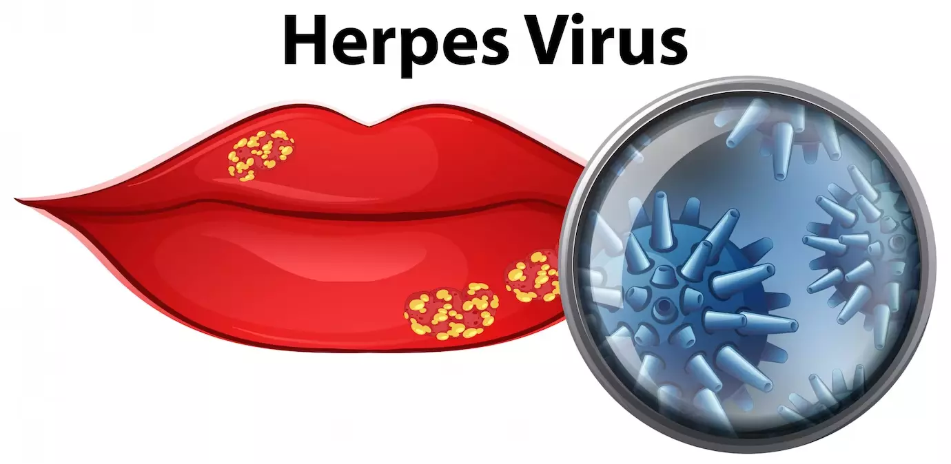 Các bệnh do virus Herpes gây ra và cách phòng ngừa