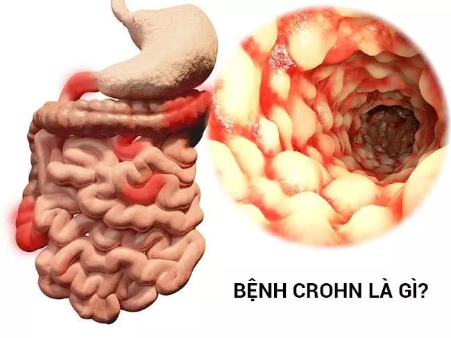 Tổng hợp những điều cần biết về bệnh Crohn