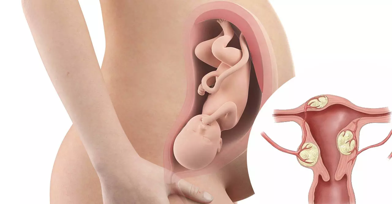 U xơ tử cung nguy hiểm với thai nhi