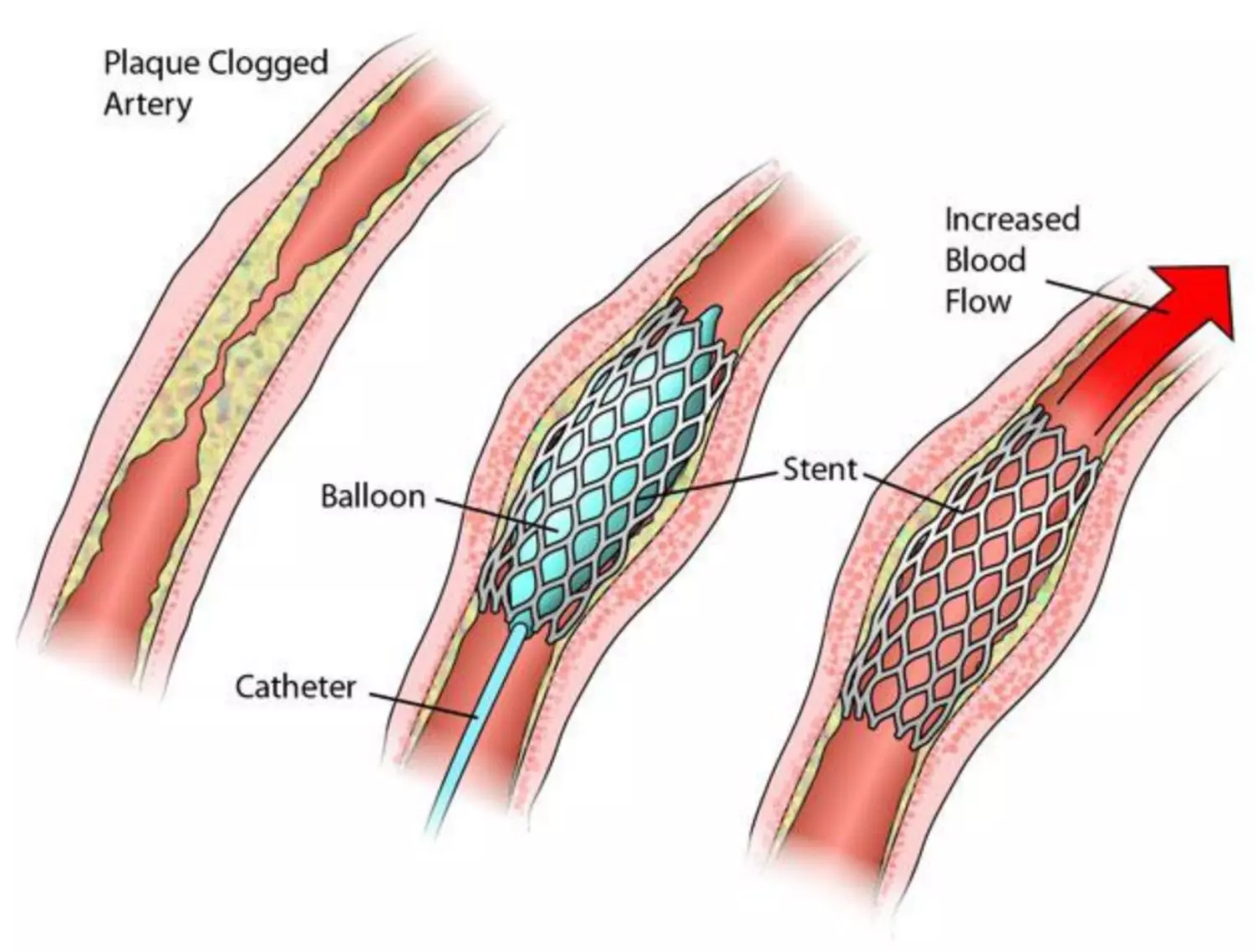 Đặt stent giúp lòng mạch được mở rộng