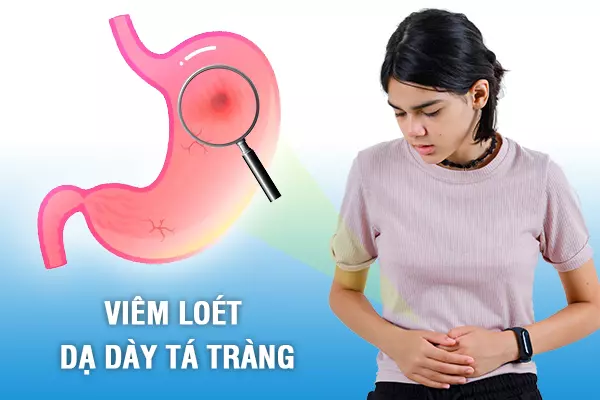 70% người Việt nhiễm loại vi khuẩn gây viêm loét dạ dày tá tràng