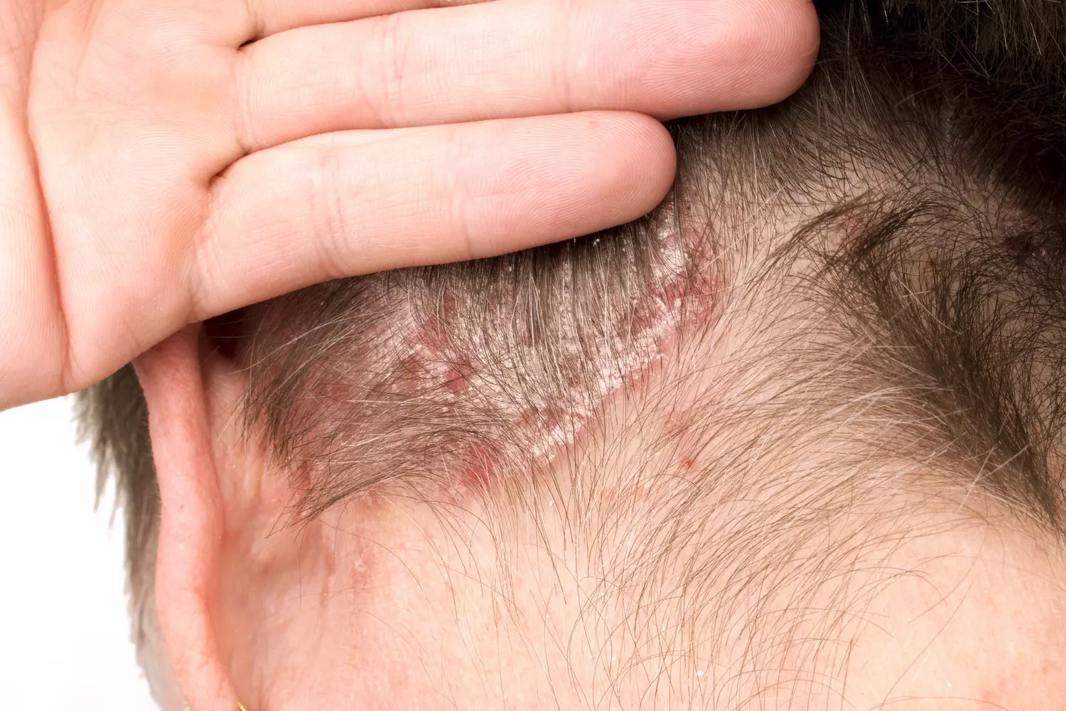 Biểu hiện viêm da tiết bã xuất hiện rõ nhất ở vùng viền chân tóc