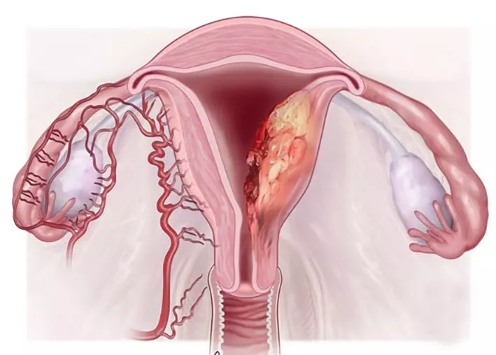 PCOS có thể làm tăng nguy cơ ung thư nội mạc tử cung
