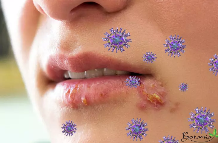 Nhiễm virus herpes