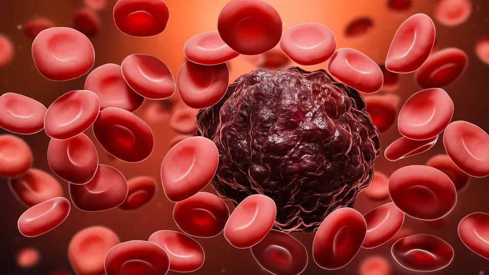 60% người bệnh ung thư máu sống được trên 5 năm nhờ ghép tế bào gốc tạo máu