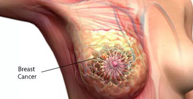Ung thư vú - Triệu chứng nhận biết và cách điều trị