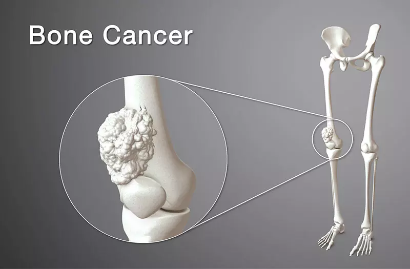 Ung thư xương - phân loại, triệu chứng và cách điều trị