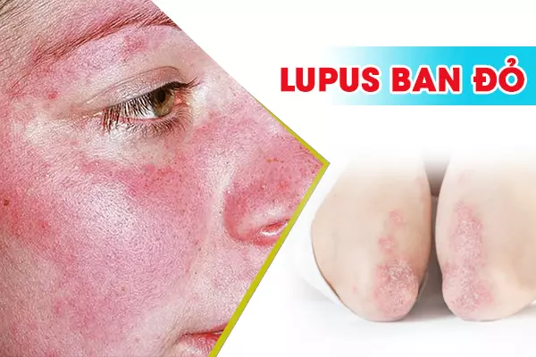 Lupus ban đỏ - Nguyên nhân, triệu chứng và cách điều trị