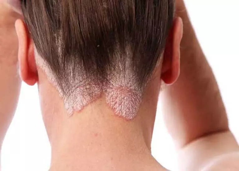 Chuyên gia giải đáp: Rụng tóc do nấm da đầu khắc phục bằng cách nào?