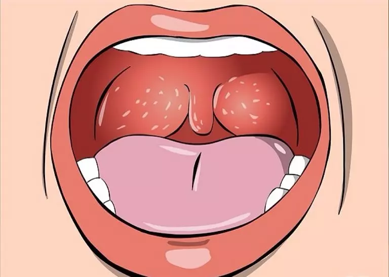 Viêm họng hạt - Triệu chứng nhận biết, cách điều trị và phòng ngừa