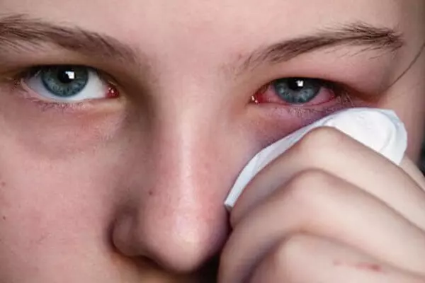 Ung thư mắt - Dấu hiệu nhận biết, các phương pháp điều trị và cách phòng ngừa