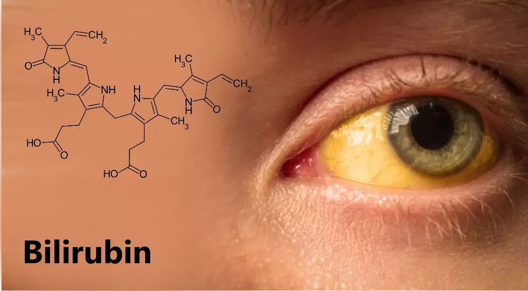 Mắt bị vàng do tăng nồng độ bilirubin trong máu