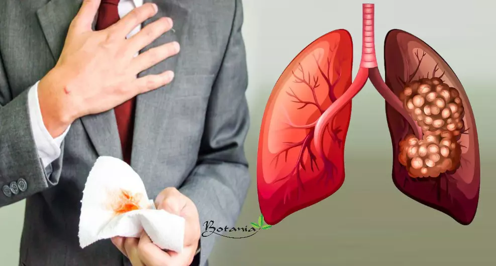 Ho ra máu có phải bị ung thư phổi không?