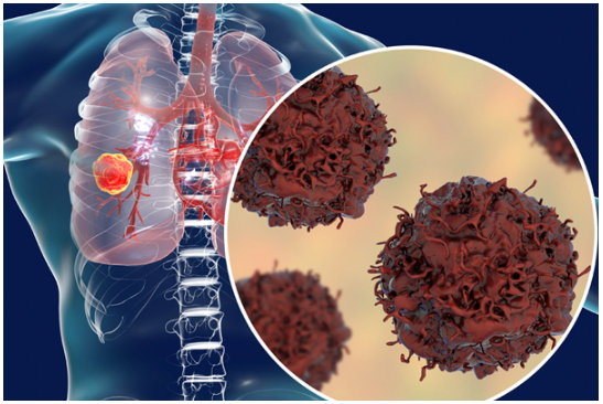 Liệu pháp miễn dịch trước và sau phẫu thuật giúp cải thiện kết quả điều trị ung thư phổi