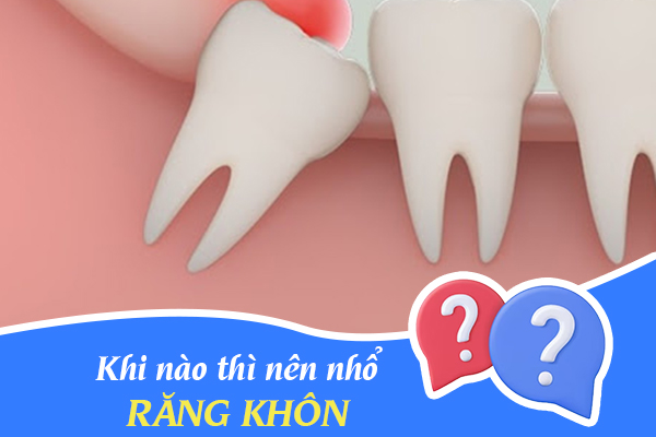 Chuyên gia giải đáp: Khi nào thì cần nhổ răng khôn?