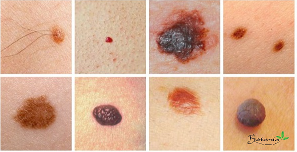 Hình ảnh một số nốt ruồi bất thường tiềm ẩn nguy cơ ung thư