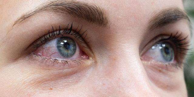 Đau mắt đỏ - Triệu chứng mới của biến thể Covid-19
