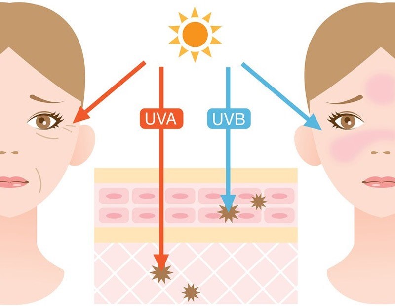 Tia UVB là tác nhân gây ra phần lớn các trường hợp nám da