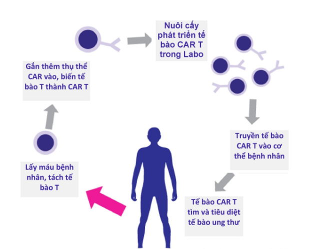 Liệu pháp CAR-T trong điều trị ung thư phổi giai đoạn 4