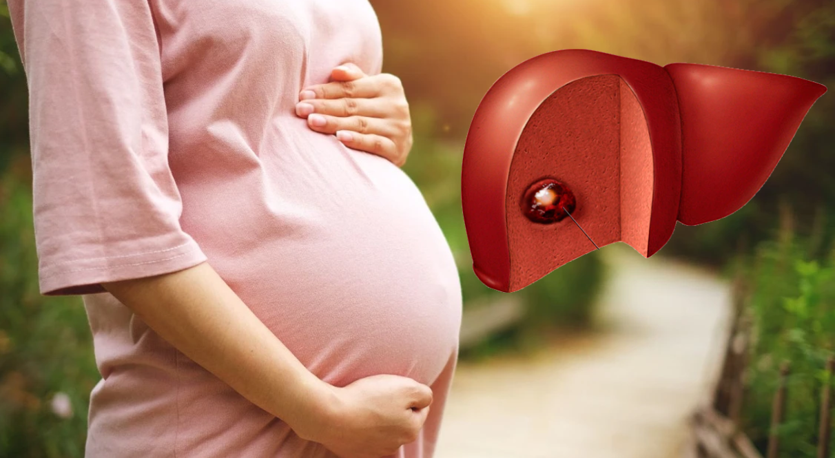 Phụ nữ có thai là một trong những đối tượng nguy cơ bị u máu gan