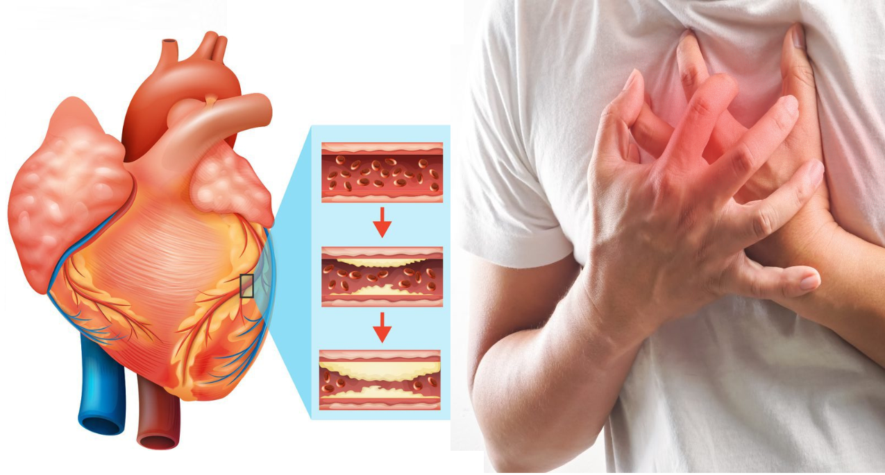  Bệnh động mạch vành là gì?