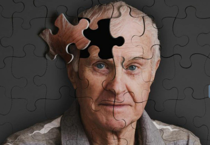 Bệnh Alzheimer - Một loại sa sút trí tuệ nghiêm trọng ở người cao tuổi