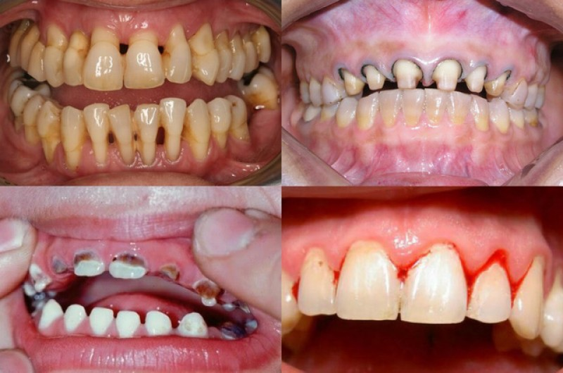 Tác hại của bọc răng sứ