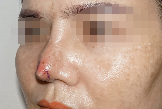 Mũi cô gái bị biến chứng nặng sau khi làm đẹp với "bác sĩ tiktok"