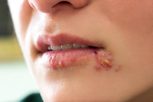 Herpes môi gây mụn rộp, đau ngứa vùng môi.