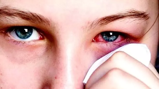 Đau mắt đỏ: Bạn biết được những gì về căn bệnh này?