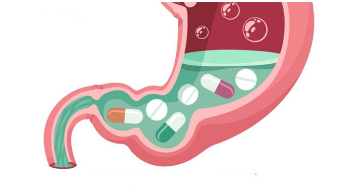 Trào ngược dạ dày thực quản cần dùng thuốc kháng acid và giảm tiết dịch vị