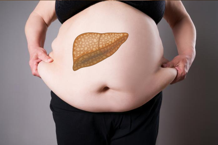 Người béo phì nên ăn các món ăn để giảm nguy cơ gan nhiễm mỡ